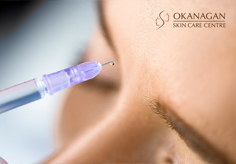 Okanagan Skin Care - blog - Botox treatment