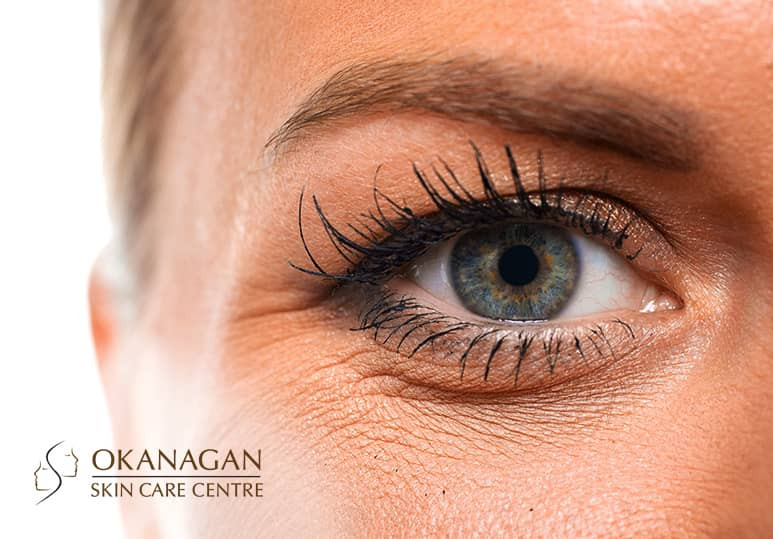 Okanagan skin - Blog - Open Your Eyes To Eyelid Thermage