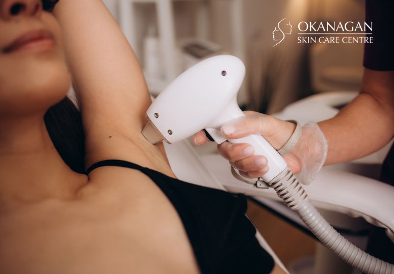 Kelowna Laser Hair Removal: 4 Reasons to Get Laser Hair Removal