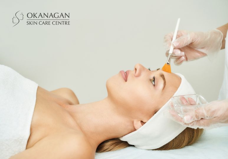 Kelowna Chemical Peels: 5 Reasons to Try Chemical Peels for Radiant Skin